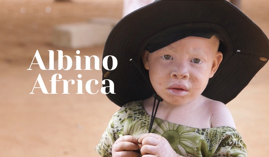 Albinos in Tanzania assaulted and maimed for the colour of their skin